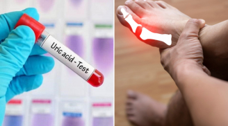 8 cách đơn giản giúp đào thải axit uric ra khỏi cơ thể, phòng ngừa bệnh gout