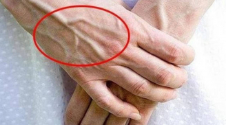 Vì sao tay xuất hiện gân xanh? Cẩn thận nếu bạn có ở những vị trí này!