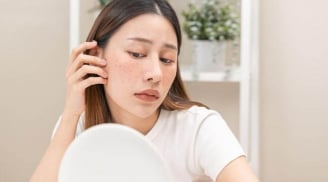 6 thói quen phổ biến khiến nám da ngày càng nặng hơn