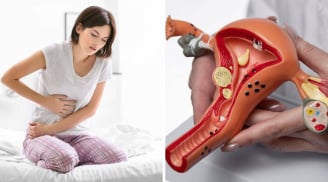 Dấu hiểu cảnh báo K cổ tử cung sớm: Phụ Nữ u 40 đang khoẻ mạnh cũng chớ xem thường