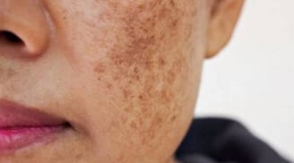 Cảnh báo ung thư: 5 vùng cơ thể đổi màu đen, dấu hiệu sớm nhiều người bỏ qua