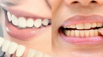 Nhìn màu răng đoán bệnh: Bác sĩ cảnh báo dấu hiệu nguy hiểm nhiều người bỏ qua
