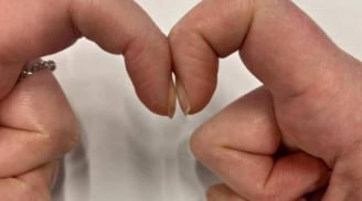 4 dấu hiệu bất thường trên ngón tay cảnh báo sớm ung thư gan, phổi