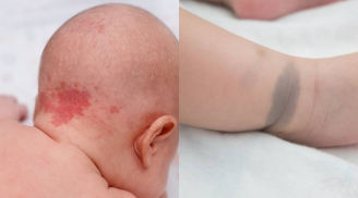 Cảnh báo: Những dấu hiệu 'nốt ruồi son - bớt - vết chàm' trên trẻ có thể tiềm ẩn nguy cơ bệnh lý