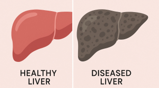 5 thực phẩm “hại gan” hàng đầu: Toàn món quen nhưng đang âm thầm tàn phá sức khỏe