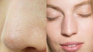 Ghim ngay 3 tips trị mụn cám vừa rẻ vừa hiệu quả chẳng tốn tiền đi spa