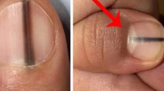 Móng tay có dấu hiệu này là gan đang 'kêu cứu', đến gặp bác sĩ ngay!
