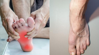 Hai bàn chân xuất hiện 5 dấu hiệu lạ, coi chừng gan đang 'kêu cứu': Hãy đi khám ngay đừng chủ quan