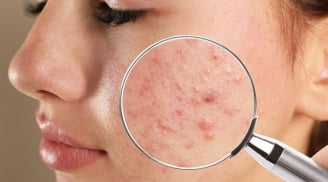 Cẩm nang chăm sóc các loại mụn ẩn nàng nên biết