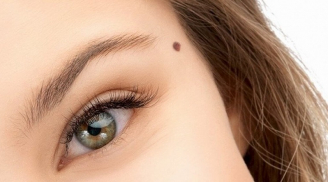 Những nốt ruồi đại phú quý: Có thì giữ, tuyệt đối đừng tẩy xóa