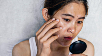 2 lưu ý cơ bản giúp cải thiện tình trạng da xỉn màu, sạm đen