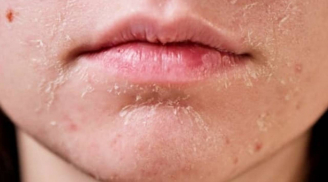 4 dấu hiệu thay đổi trên khuôn mặt cảnh báo ung thư cổ tử cung, phụ nữ cần lưu ý ngay