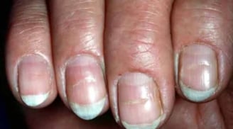 5 dấu hiệu bất thường trên móng tay cảnh báo ung thư: Đừng chủ quan kẻo phát hiện quá muộn
