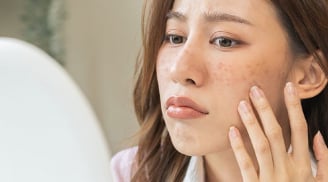Sai lầm khiến tình trạng nám và đốm đen trở nên trầm trọng