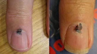 Cảnh báo sức khỏe: 6 bộ phận màu đen thường báo hiệu nguy cơ ung thư, đừng chủ quan!