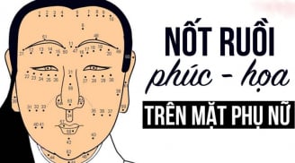 4 nốt ruồi chặn cửa tài lộc: Nên xóa bỏ