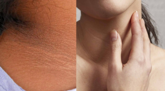 Nhìn thấy dấu hiệu này trên da, cẩn thận Tiểu Đường tới gần