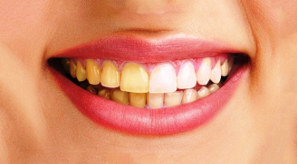 6 loại thực phẩm quen thuộc nhiều người thích mê khiến răng ố vàng dù đánh răng đều đặn mỗi ngày
