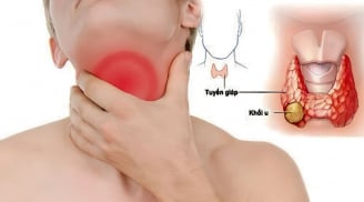7 dấu hiệu sớm của K tuyến giáp, nhiều người chủ quan bỏ qua