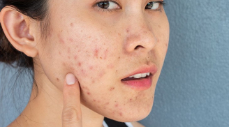 Một làn da đẹp không phải là làn da “sạch bóng” dầu