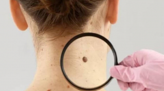 3 dấu hiệu “đen” trên cơ thể cảnh báo ung thư cận kề: Tuyệt đối đừng chủ quan kẻo quá muộn!