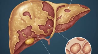 Món ăn quen thuộc này mới là “sát thủ phá gan” mạnh nhất, không phải rượu như nhiều người nghĩ