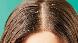 4 mẹo cơ bản giúp bạn nói lời 'tạm biệt' với gàu