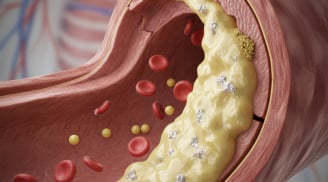 Nguy cơ đột quỵ tăng vọt: 3 hành vi hại mạch máu người trẻ thường mắc