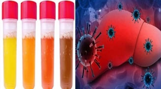 Buổi sáng thức dậy thấy 4 dấu hiệu này: Sợ rằng gan đã 'rỗ như tổ ong', phải đi khám ngay