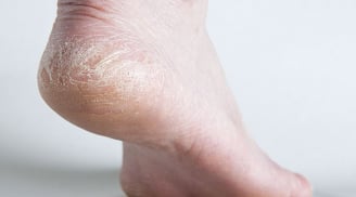 Mẹo giai quyết tình trạng da gót chân khô, nứt nẻ
