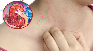 6 dấu hiệu cảnh báo suy thận, nhiều người bỏ qua