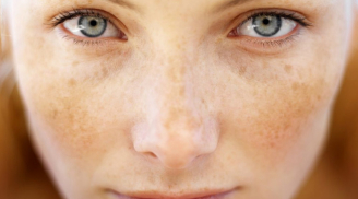 3 loại nước ép giàu vitamin A và C chăm sóc làn da và trị nám cực hiệu quả