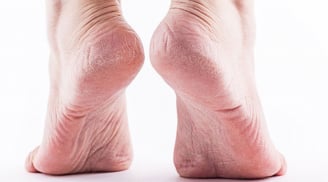 Nứt nẻ gót chân không phải lúc nào cũng do khô, hãy lưu ý những tình trạng này