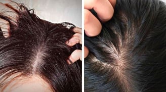 4 cách trị gàu tự nhiên giúp 'đánh bay' nỗi lo về mái tóc nhiều gàu