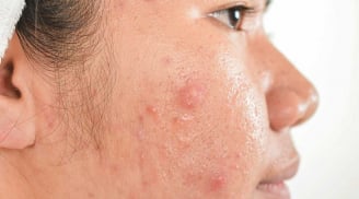 Cách chăm sóc da mụn đúng cách trong mùa đông