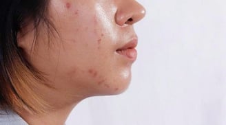 Cách kiểm soát dầu nhờn hiệu quả cho da mặt