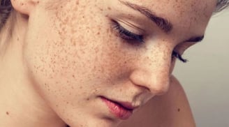 Nguyên nhân hình thành các đốm màu trên da