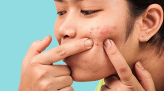 Vì sao chăm sóc da kỹ vẫn bị mụn?