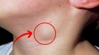 3 dấu hiệu bất thường ở vùng cổ cảnh báo K: Nhiều người chủ quan đã quá muộn