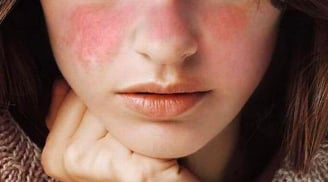 Da đẩy mụn khi dùng retinol: Hiểu đúng để không hoang mang