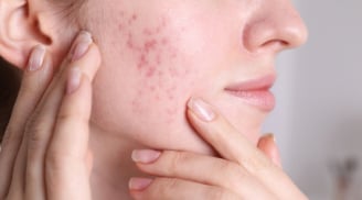 Thâm mụn và lộ trình chăm sóc giúp da phục hồi nhanh hơn