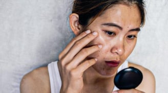 5 dấu hiệu cho thấy khí huyết của chị em đang bị suy yếu