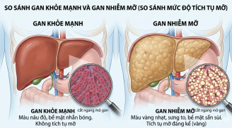 Gan nhiễm mỡ tăng nhanh ở người Việt: Bác sĩ chỉ ra 3 thói quen quen thuộc nhiều người mắc phải