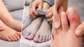 3 dấu hiệu ở chân có thể đang cảnh báo bệnh nguy hiểm, nhiều người thường bỏ qua