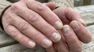 Tay và chân xuất hiện 7 dấu hiệu này, có thể là tín hiệu thận đang gặp vấn đề