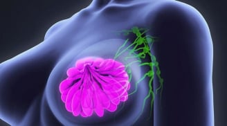 5 dấu hiệu ung thư vú dễ nhận biết nhưng nhiều người bỏ qua: Cẩn thận di căn xa