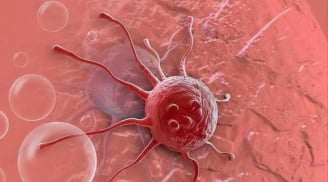 3 căn bệnh ung thư này tiến triển với tốc độ đáng báo động, cách phát hiện sớm