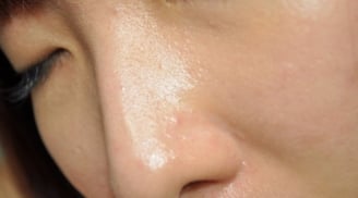 4 nguyên nhân khiến lỗ chân lông to và cách chăm sóc phù hợp cho từng tình trạng da