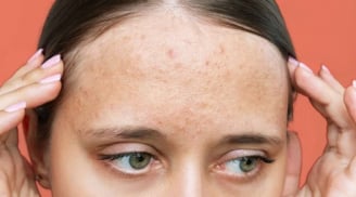 Nhận diện sẹo rỗ và 5 phương pháp cải thiện giúp làn da dần mịn màng hơn