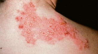 Đây là 3 căn bệnh được y học đánh giá là gây đau đớn nhất